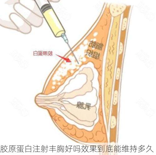 胶原蛋白注射丰胸好吗效果到底能维持多久